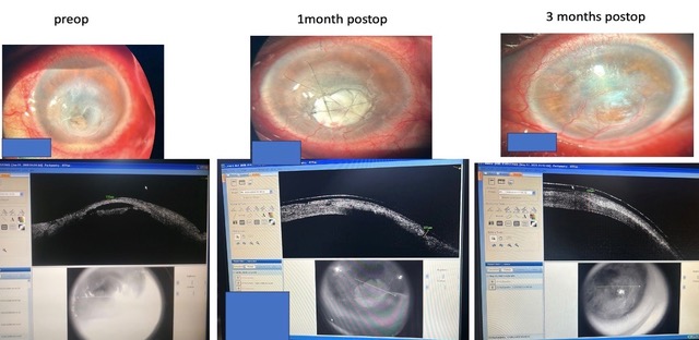 Anterior segment OCT pictures taken during follow-up visit
