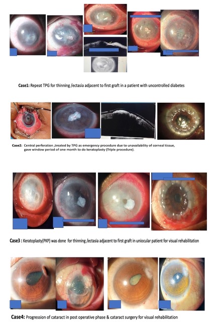 Slit lamp pics of patients undergoing different types of additional surgical intervention during post op period after TPG for managing complications and visual rehabilitation