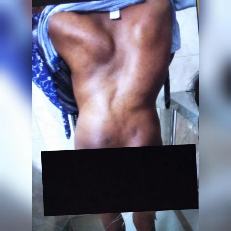 23 yr old Kyphoscoliotic primigravida posted for emergency c-section