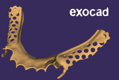 Use of exocad software to design the framework for partially edentulous model.
