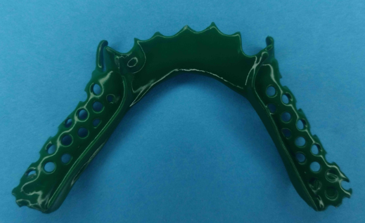 Cast partial denture framework fabricated using SLA castable resin.