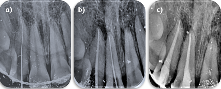 a: Working length IOPA; b: Master cone IOPA; c: Post obturation IOPA