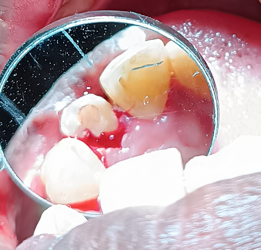 Preoperative image after encountering crown root fracture.