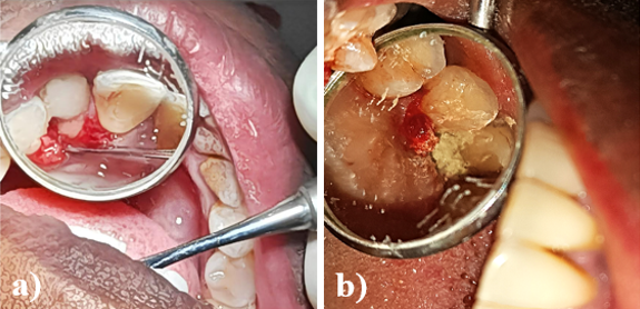 a: Surgical exposure of fracture site locating fracture line extending 4mm below alveolar crest; b: Biodentine placement on fractured site.