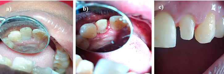 a: Post-operative image after one week; b,c: Tooth preparation for PFM crown.