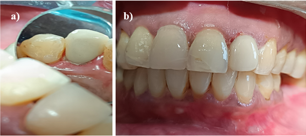 a,b: Post-operative images immediately after crown cementation.