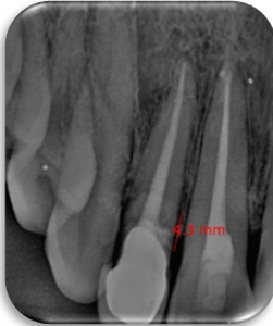 IOPA depicting 4.3mm extent of bio dentine.