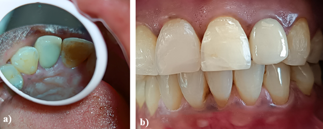 a,b: One year follow up image