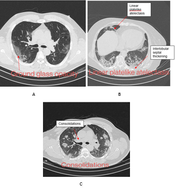 a:, b: and c: images from different patients show patchy peripheral ground-glass opacities, Linear platelike atelectasis and peripheral patchy consolidation areas respectively.