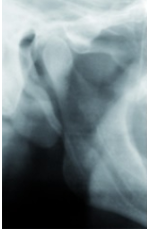Styloid process elongation type-I