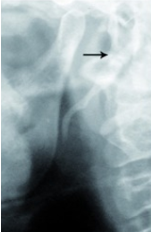 Styloid process elongation type-II