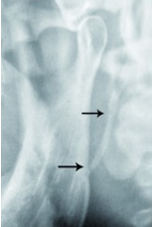 Styloid process elongation type-III