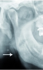 Styloid process elongation type-IV