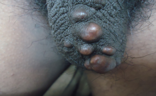 Epidermoid Cyst over scrotum