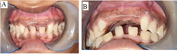 A: Preoperative intraoral view; B: Class II relation