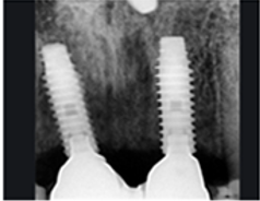 Periapical radiographs on 11 and 21