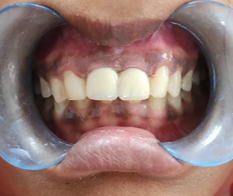 Final porcelain fused to metal prosthesis in 11 and 21