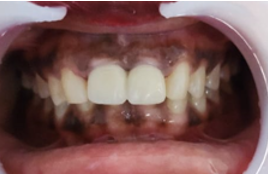 After 3 months-intraoral view.