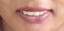 Visibility on smile