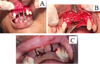A: Parallel pin placed; B: 3.3×11.5mm DIO implants placed; C: Simple interrupted sutures were given