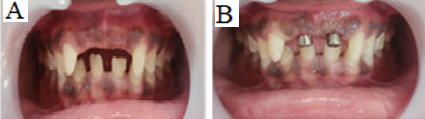 A: Satisfactory healing after 3 months; B: Healing abutment palced