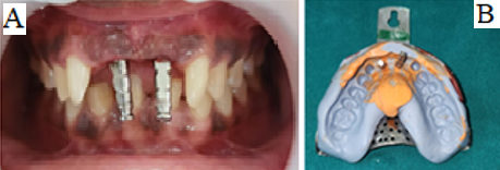 A: Impression coping placed; B: Closed try impression with coping and lab analog on place