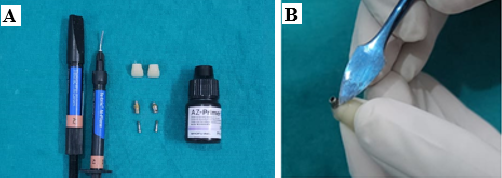 A: Acrylic tooth, metal primer, flowable and packable microfilled composite; B: Addition of composite to create emergence profile