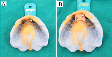 A: Implant level impression using a closed tray method; B: Gingival mask applied