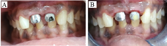 A: Customized screw retained metal abutments on 11 and 21; B: Access hole was sealed with Teflon and restored with flowablecomposite