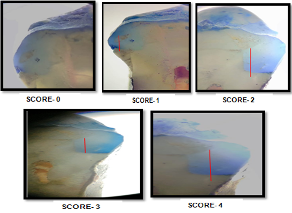 Gingival marginal micro leakage evaluation after sectioning