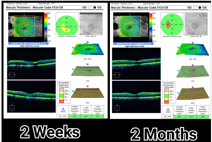 SDOCT of left eye at 2 weeks and 2 months