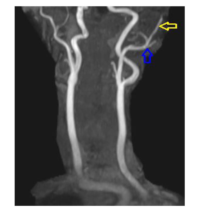 MR angiogram showing ascending pharyngeal artery arising from occipital artery on the left side. Blue arrow – occipital artery & Yellow arrow - ascending pharyngeal artery