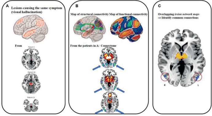 Applyinghuman brain connectome (HBC) to identify the signs feature-manifestations (symptoms). 27