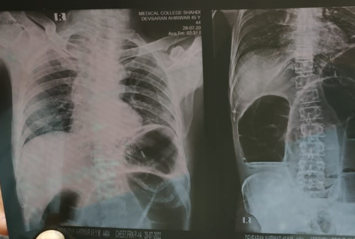 X-Ray of sigmoid volvulus
