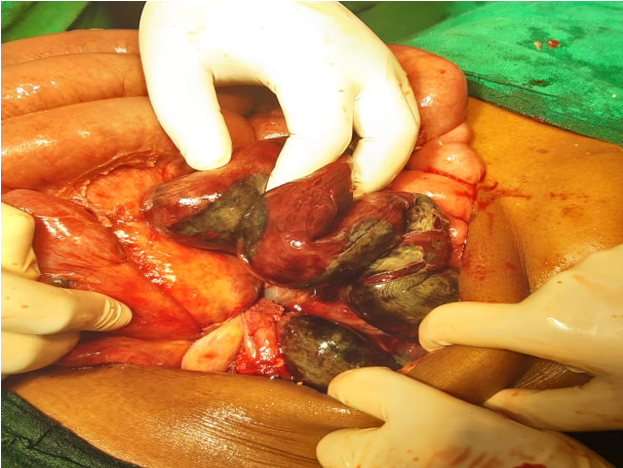 Intraoperative finding- gangrenous colon