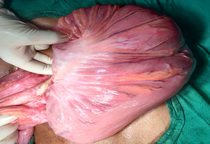 Intraoperative finding- large colonic distension