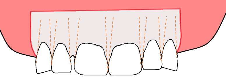 Corticotomy 1 Orange marking denotes corticotomy cuts.