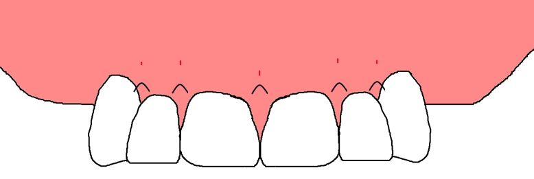 Suture placement 1 Non-resorbable interrupted sutures are placed to proximate gingival flaps.