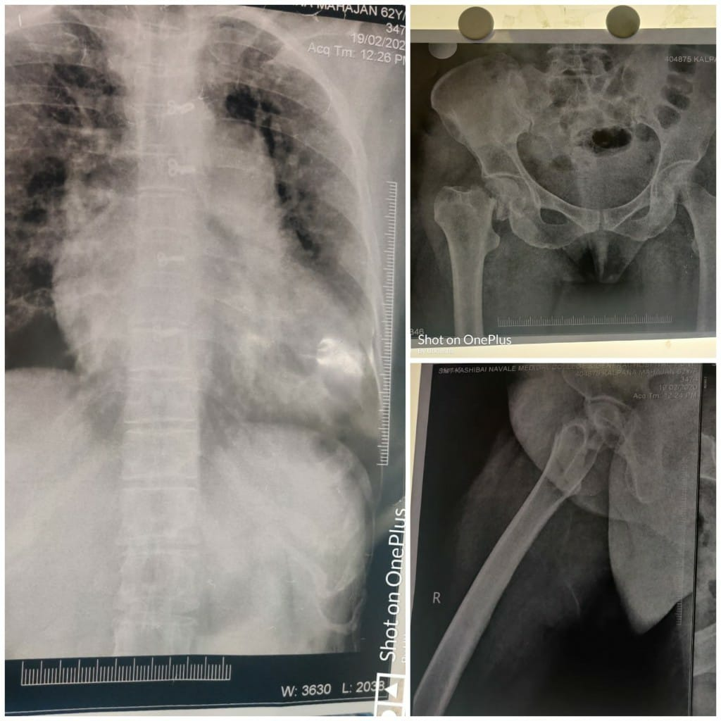 CXR and X-ray PHB