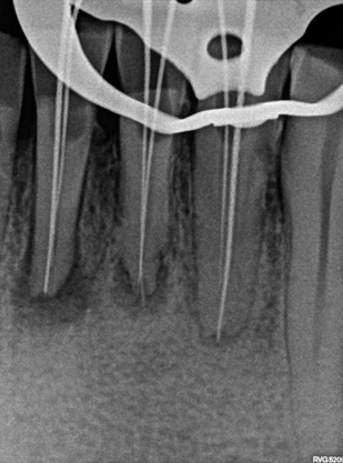 Working length Radiograph