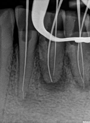 .Working Length Radiograph with 30 degree angulation