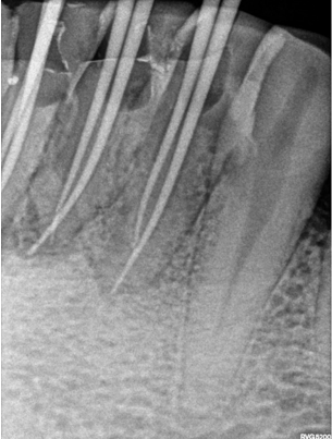 Master Cone Radiograph