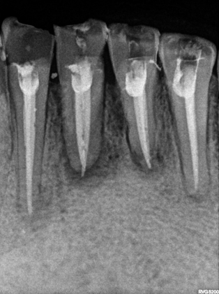 PostObturation Radiograph