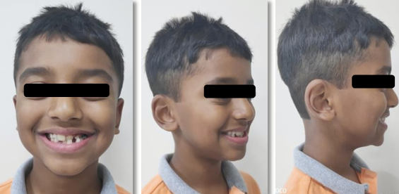 Pre-treatment extra-oral pictures on smiling
