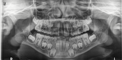 Showing OPG representing the early mixed dentition