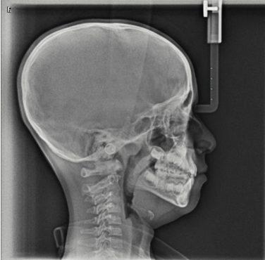 Showing lateral cephalogram of the patient.