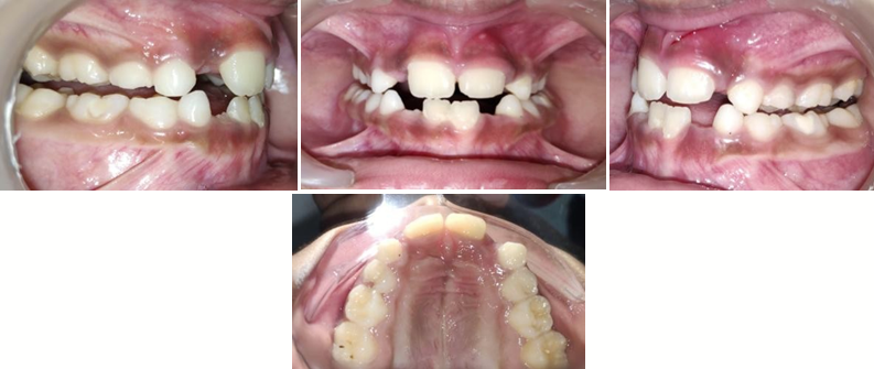 Post correction intra-Oral pictures