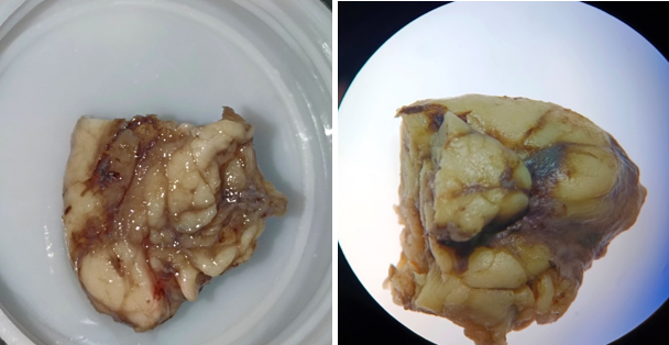 Lymph node under normal camera vs stereomicroscope