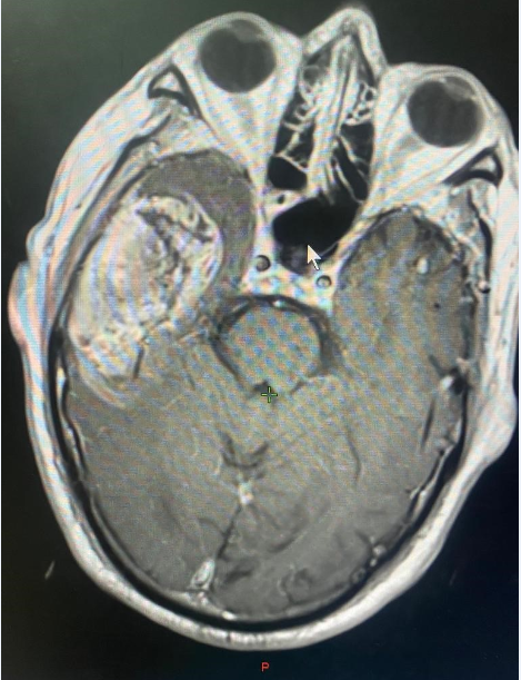 Showing MRI of Oligodendroglioma grade II