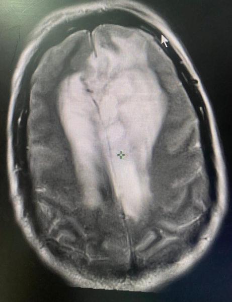 Showing MRI of anaplastic astrocytoma